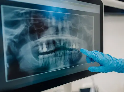 親知らずの抜歯