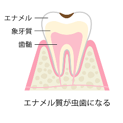 エナメル質が虫歯になる