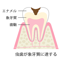 虫歯が象牙質に達する