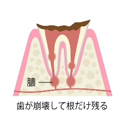 歯が崩壊して根だけ残る