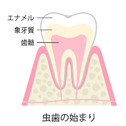 虫歯のはじまり