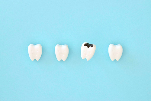 虫歯がある口内のイラスト