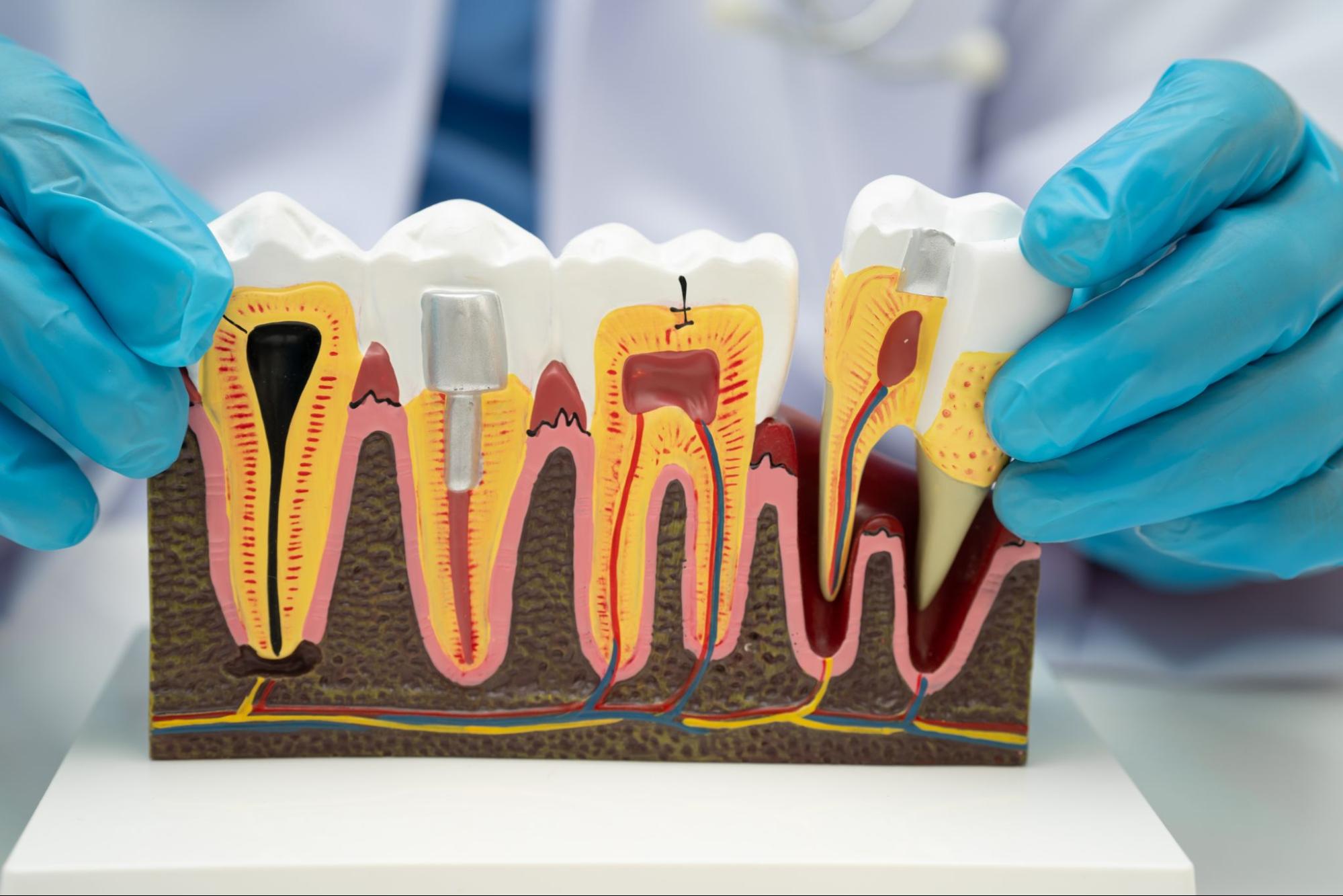 歯根端切除の説明図