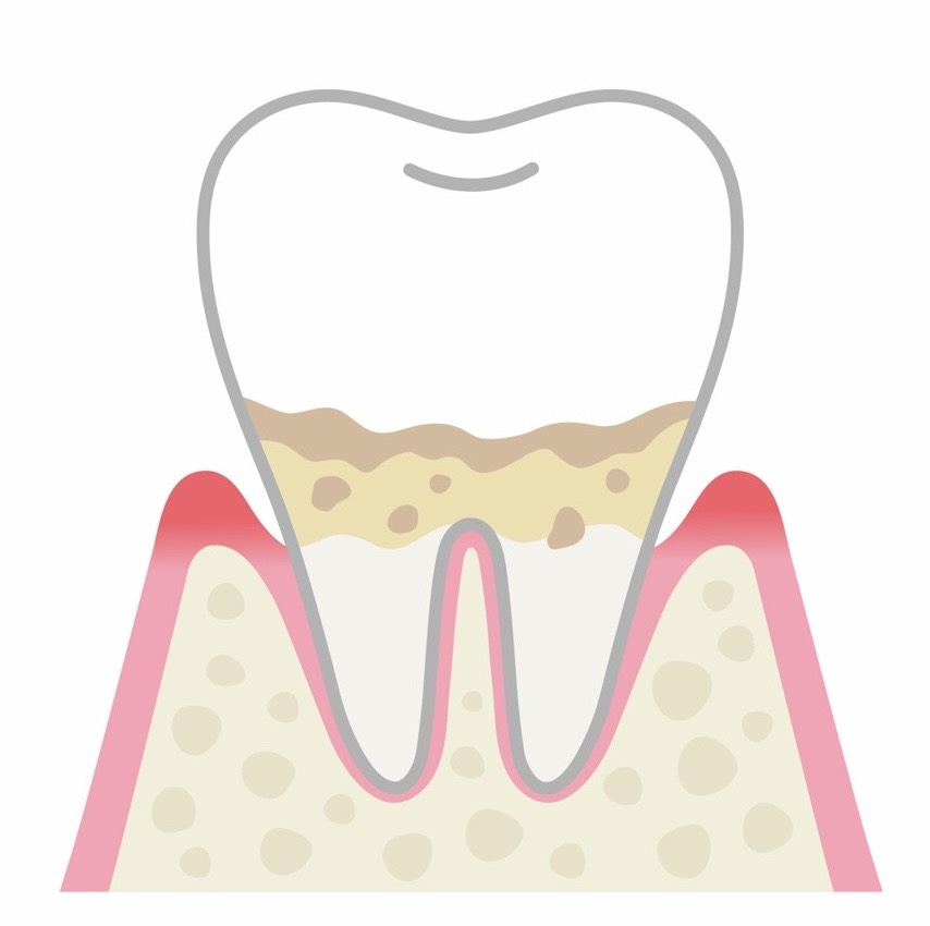 軽度歯周炎の状態