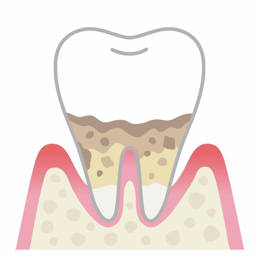 中等度歯周炎の状態