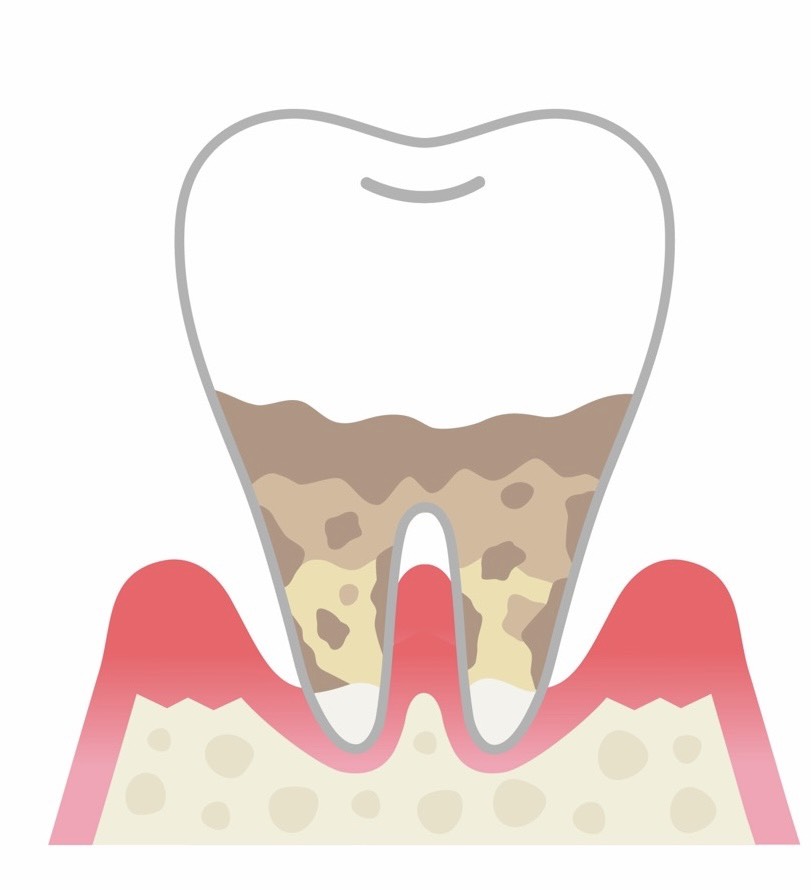 重度歯周炎の状態