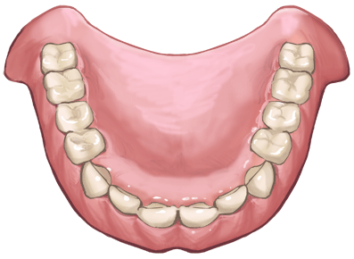 保険診療の入れ歯